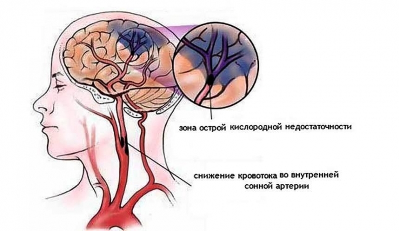 Последствия недостатка поступления кислорода в головной мозг: причины, симптомы и лечение Последствия недостатка поступления кислорода в головной мозг: причины, симптомы и лечение